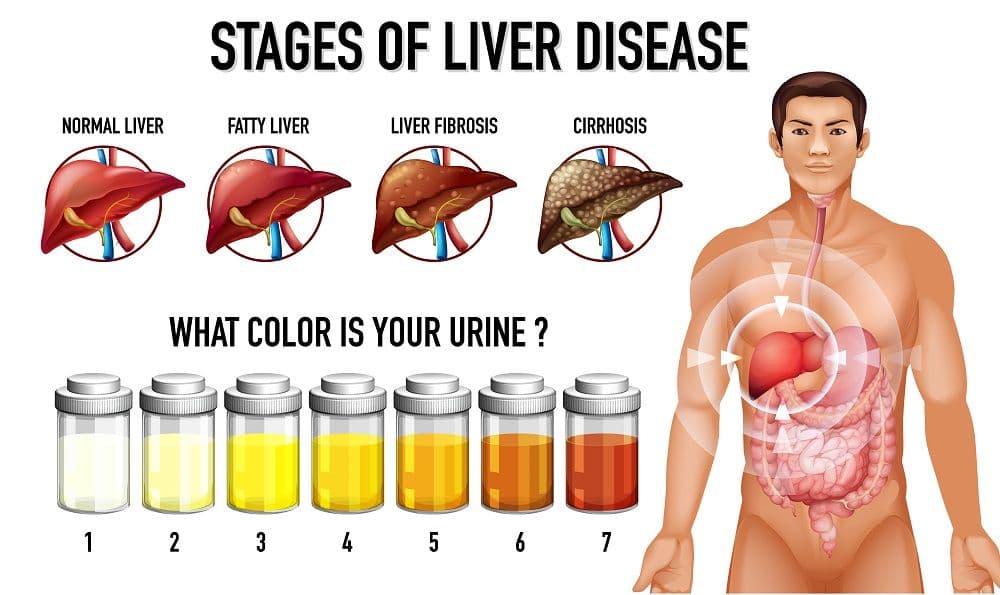 Fatty Liver