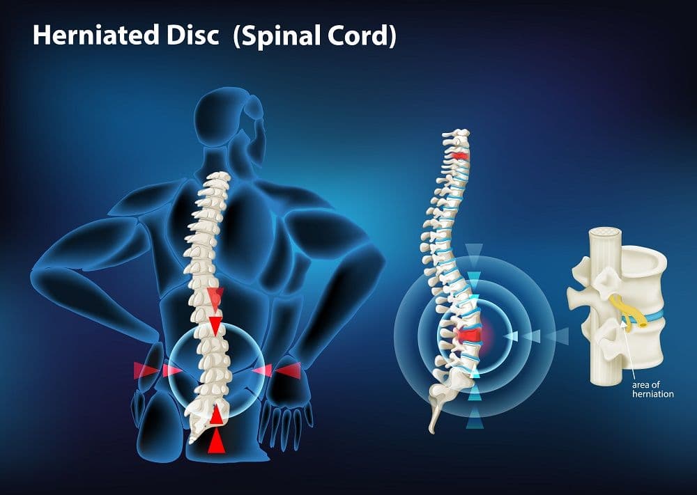 Spinal Cord Injury