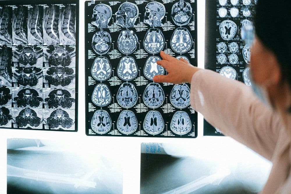 Stem Cell Therapy for Neurological Disorders: Unlocking the Potential of Regeneration